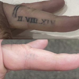 Tattoo Removal Photos News Cost Reviews Locate Provider  AHB